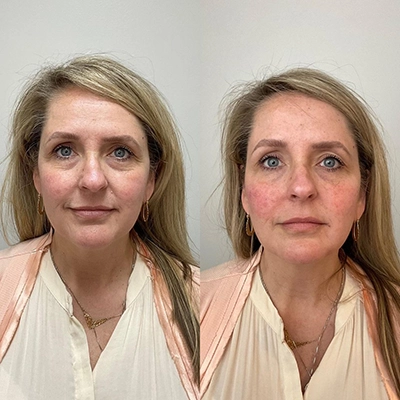 filler facelift copy