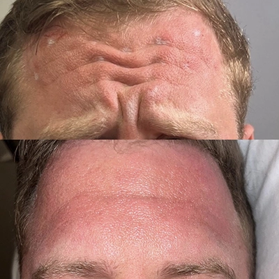 botox
