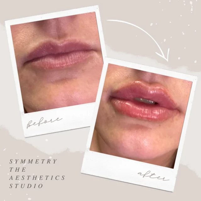 Asymmetry to SYMMETRY 🪩 
Lips by Liz! Ask us how you can get 1.2ml of longer lasting filler for $650! (606)547-2231