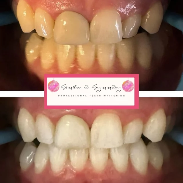 @similee_at_symmetry  is now booking teeth whitening! She does amazing work and this is after one session! Her first day at Symmetry is Botox Day, 11/20!
Call or text (606)547-2231