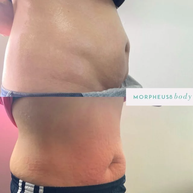 Turn your post notifications ON 
You won’t want to miss this 12 days of Christmas deal 🎄
@inmodeaesthetics #morpheusbody #Morpheus8Verified